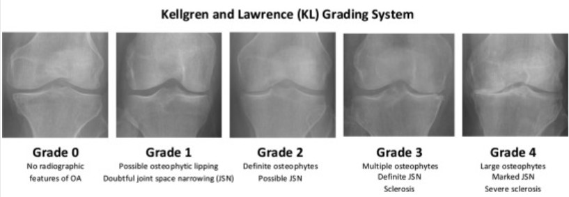 Find Relief from Arthritis Pain: Natural Medicine Treatments