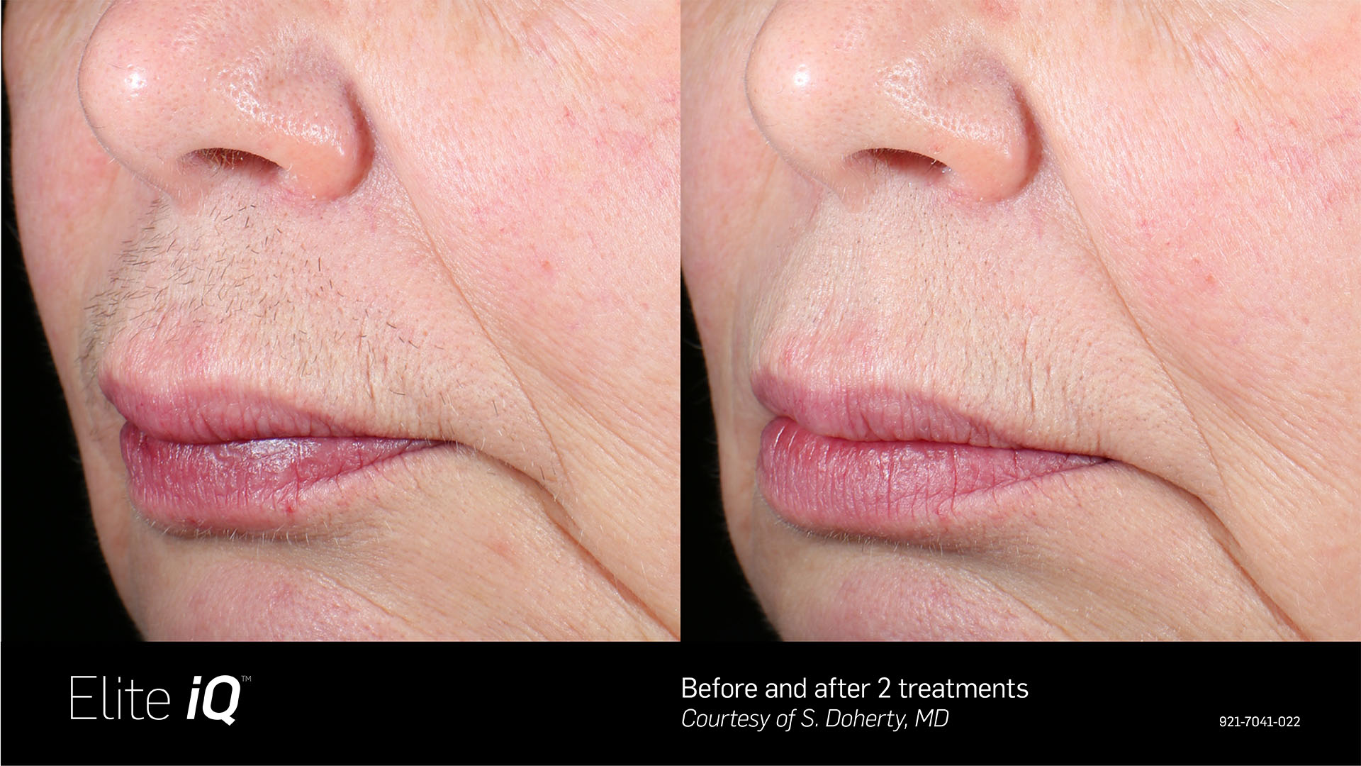Side profile before and after photo showing a woman's upper lip with hair before and smoother, more hairless skin after Elite IQ laser hair removal treatment in St. Petersburg.