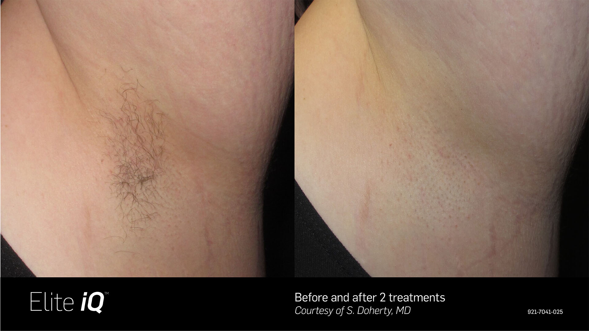 Before and after photo showing a woman's underarm with hair before and smooth, hairless skin after laser hair removal treatment with Elite IQ at Water's Edge Medical Clinic.