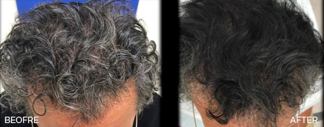 Hair-Restoration-before-and-after-2-Water-Edge-Medical-Clinic-St
