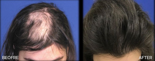 Hair-Restoration-before-and-after1-Water-Edge-Medical-Clinic-St
