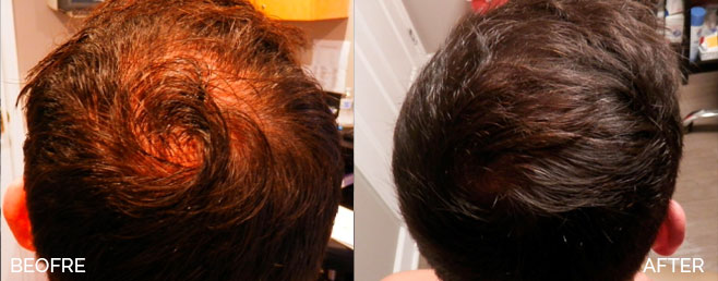 Hair-Restoration-before-and-after3-Water-Edge-Medical-Clinic-St