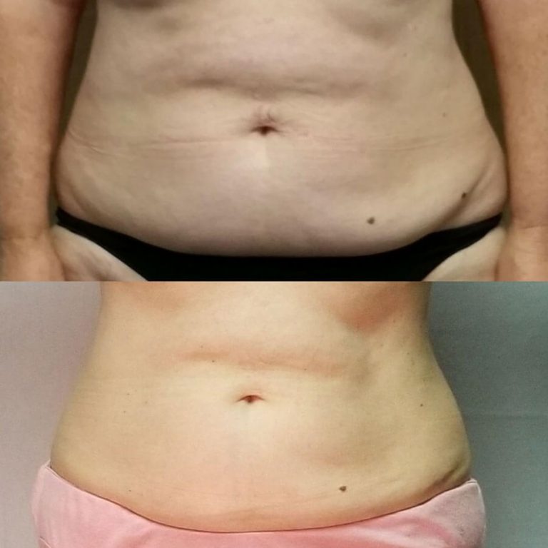 Before and after image of woman's abdomen showing less fat after Semaglutide weight loss treatment at Water's Edge Medical Clinic and Spa.
