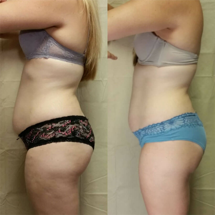 Before and after image of woman's abdomen and thighs showing less fat after Semaglutide treatment in St. Petersburg, Florida.