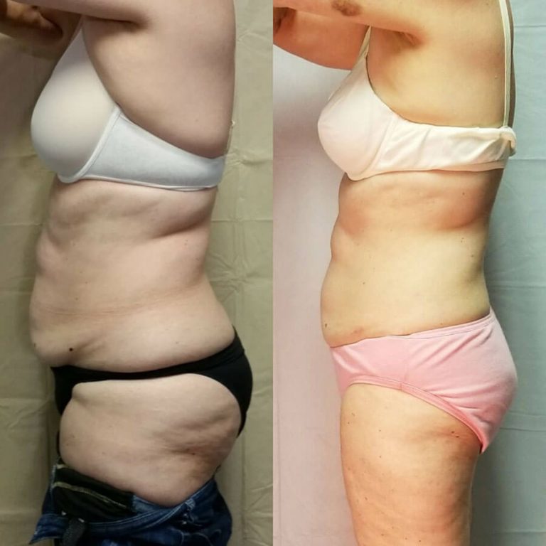 Before and after image of woman's abdomen and thighs after Semaglutide weight loss treatment in St. Petersburg, Florida.