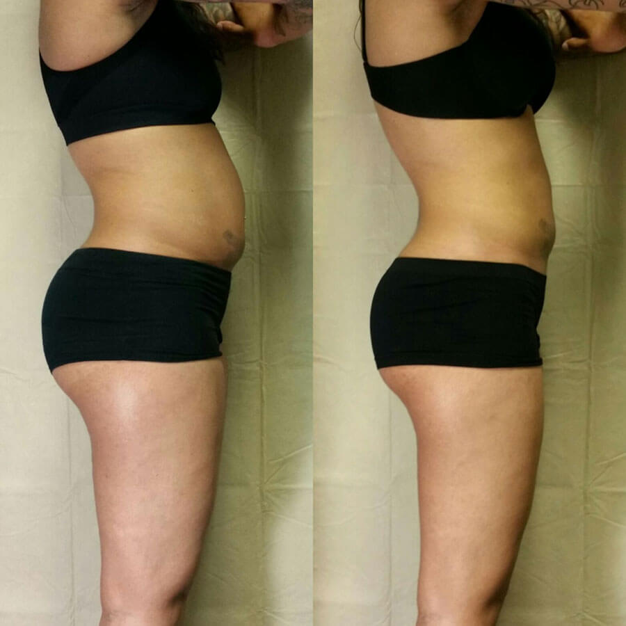 Before and after photo of a woman's abdomen after Semaglutide treatment at Water's Edge Medical Clinic and Spa.