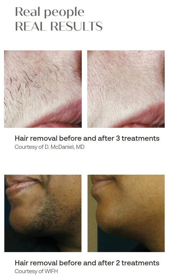 Hair Removal Before and After