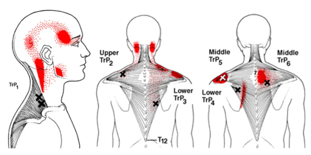Neck-Trigger-Points-Waters-Edge-Medical-Clinic.webp
