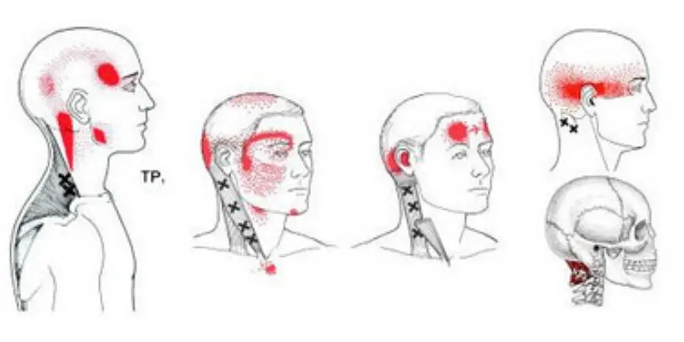 Trigger Points for Headaches 1 - Waters Edge Medical Clinic