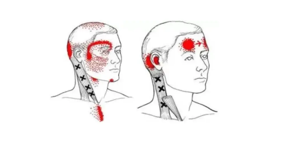 Trigger Points for Headaches 2 - Waters Edge Medical Clinic