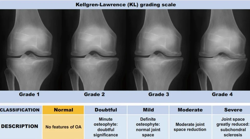 Normal Knee vs Osteoarthritis