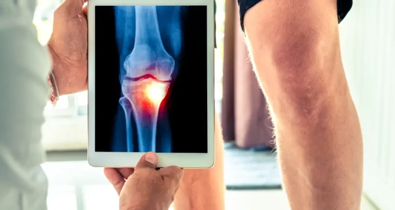 Normal Knee vs Osteoarthritis Best Insight Waters Edge Medical Clinic Normal Knee vs Osteoarthritis Best Insight