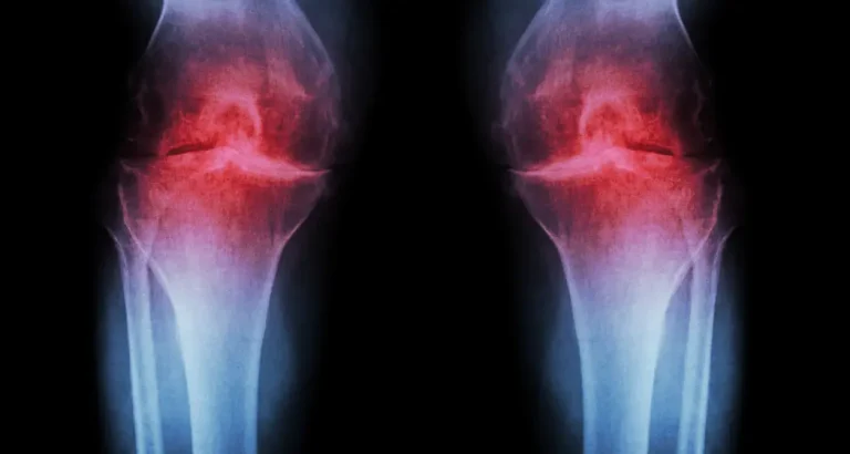 Osteoarthritis of the knee Waters Edge Medical Clinic Osteoarthritis of the knee