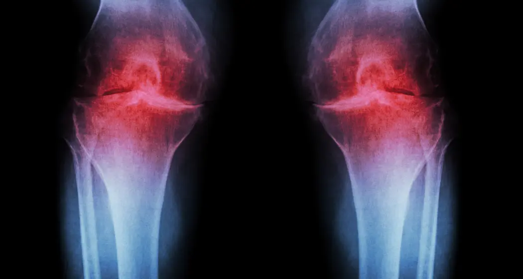 Osteoarthritis of the knee