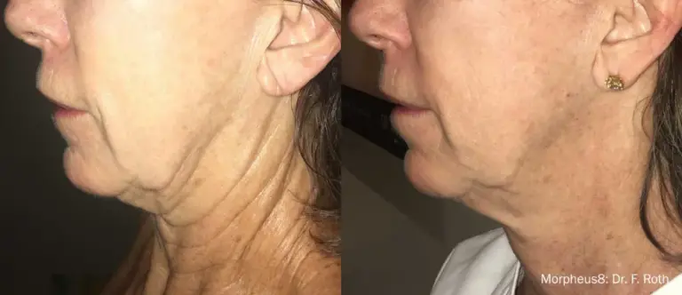 Anti-aging with Morpheus9 Before and After Client 2