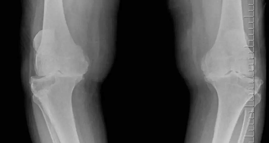 knee joint, normal knee x-ray
