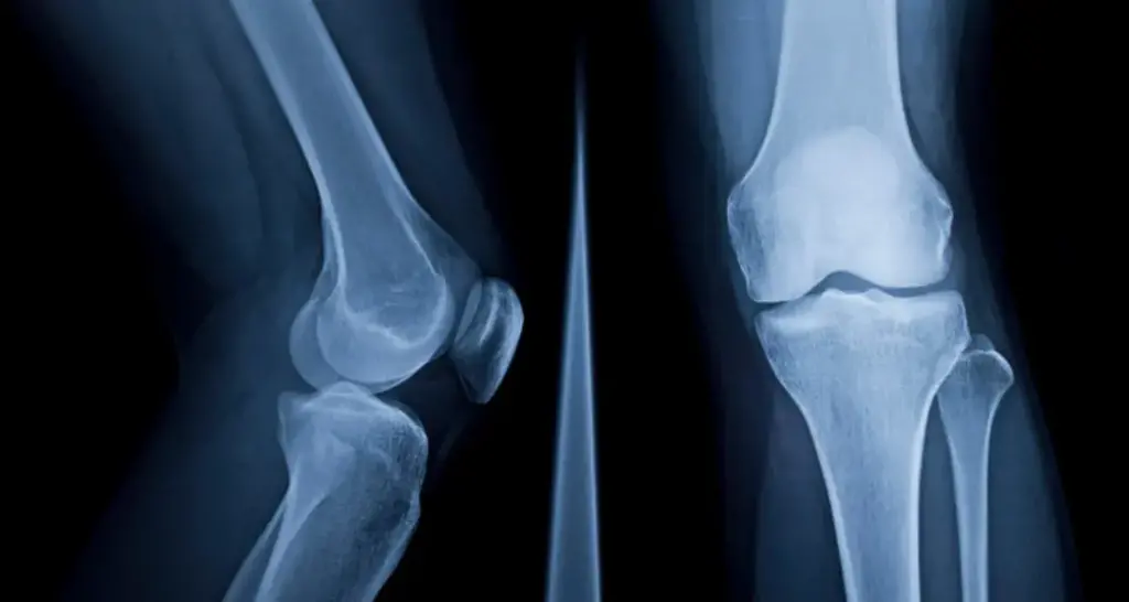 Knee joint, healthy knee joint, knee x-ray