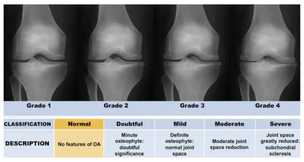 knee joint x ray , knee x ray normal , xray knee normal