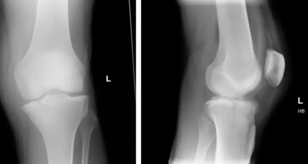 knee joint x ray,
normal normal vs abnormal knee x ray 
