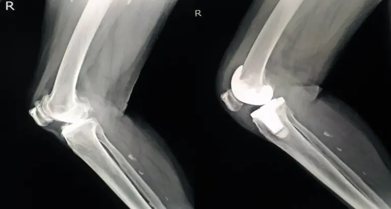 Understanding a Knee Joint XRay Waters Edge Medical Clinic Understanding a Knee Joint X Ray