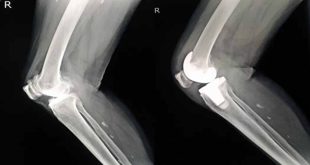Understanding a Knee Joint X-Ray