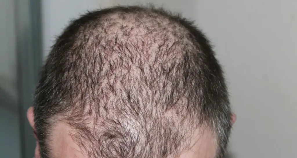 non surgical hair restoration cost, where to get prp injections for hair loss