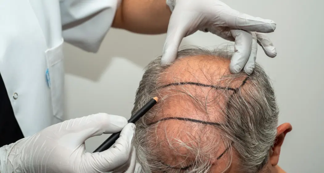 Hair Restoration or Hair Transplant What's Right for You