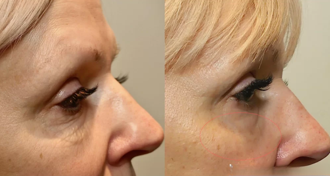 AntiAging Clinic Experience Morpheus8 Skin Tightening Now Waters Edge Medical Clinic Anti Aging Clinic Experience Morpheus8 Skin Tightening Now