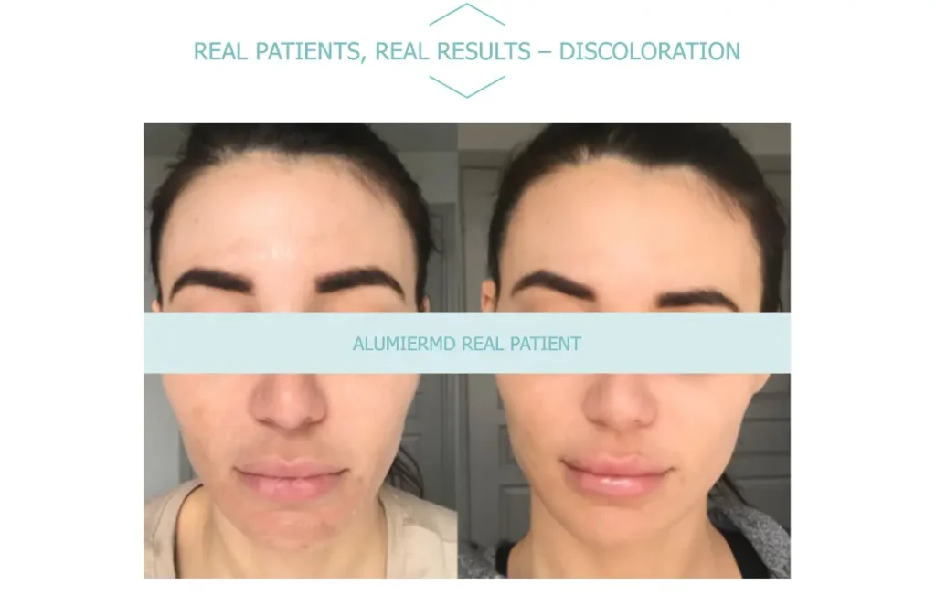 AllumierMD B+A 4 Waters Edge Medical Clinic AllumierMD B+A 4