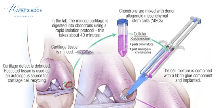 How Much Does Regenerative Knee Treatment Cost