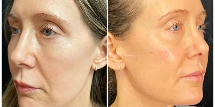 Morpheus8 Skin Tightening Before and After