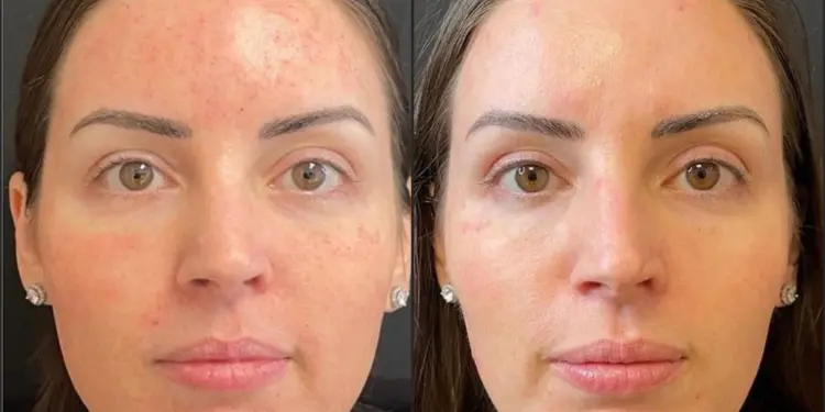 What to Expect from Morpheus8 After Just 1 Treatment