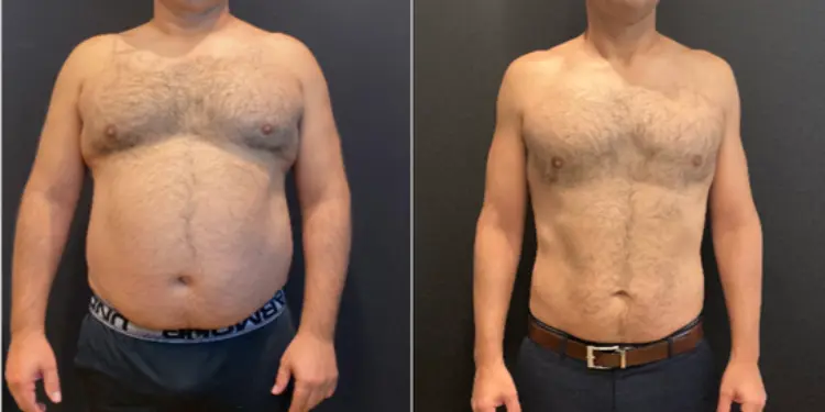 semaglutide weight loss before and after