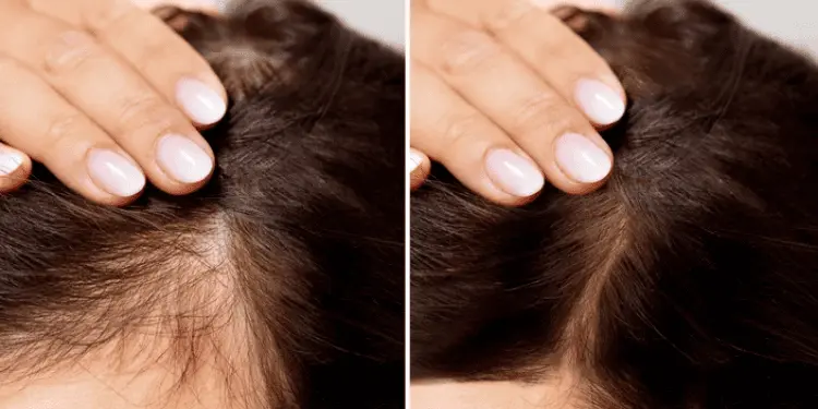 Best Hair Restoration Specialists for Women and Men Waters Edge Medical Clinic Best Hair Restoration Specialists for Women and Men